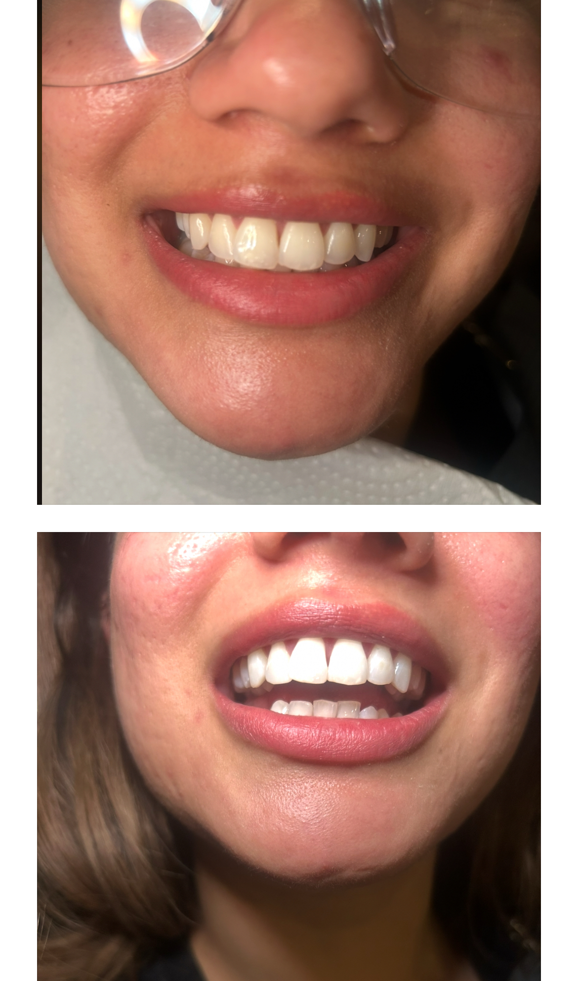 Before and After