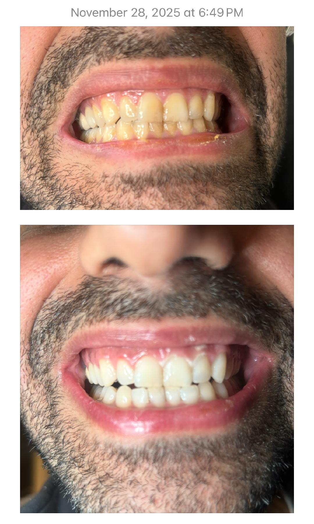 Before and After